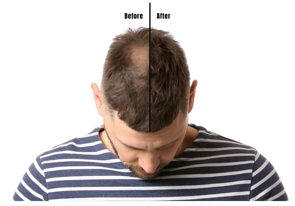 finasteride before and after